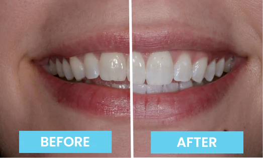 LumiCare Brush